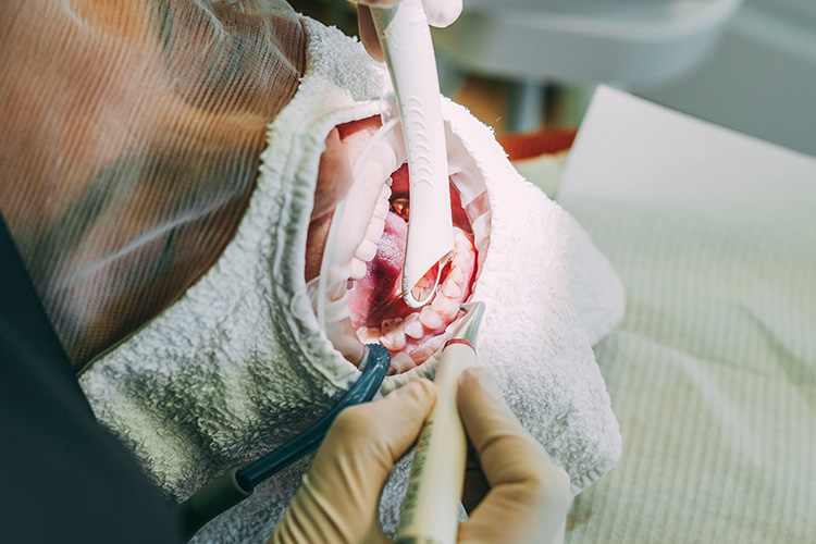 Eine Detailaufnahme eines offenen Mundes während einer professionellen Zahnreinigung in der Zahnarztpraxis Matthias Theel in Hilpoltstein