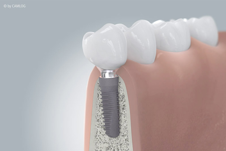 Eine Detailaufnahme eines 3D-Modells von einem Implantat in der Zahnarztpraxis Matthias Theel in Hilpoltstein